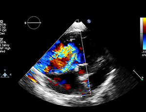 Renal Artery Doppler